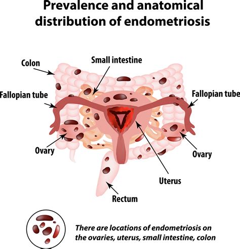 endometriose was ist das